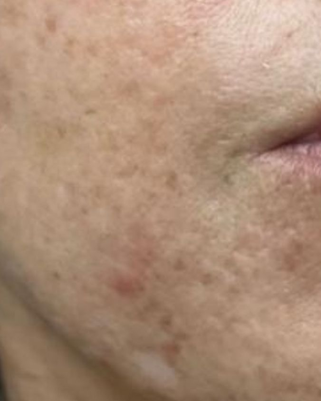 Before treatment