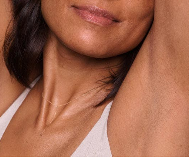 laser hair removal
